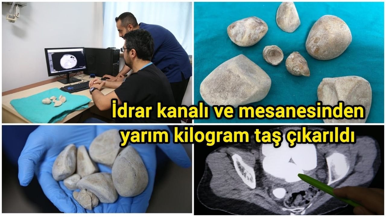 İdrar kanalı ve mesanesinden yarım kilogram taş çıkarıldı