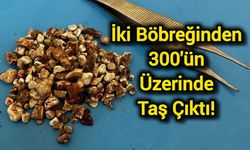İki böbreğinden 300'ün üzerinde taş çıktı!