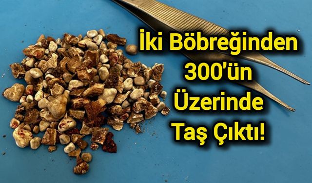 İki böbreğinden 300'ün üzerinde taş çıktı!